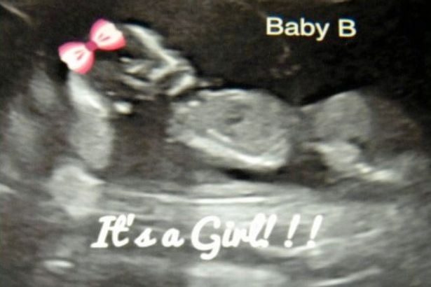 
Một người nhận gửi ảnh siêu âm đã thụ thai thành công cho Matt
