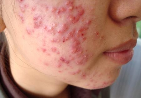 Ham trắng da siêu tốc, chị em khóc mếu vì kem trộn - 3 Ham trắng da siêu tốc, chị em khóc mếu vì kem trộn - 3