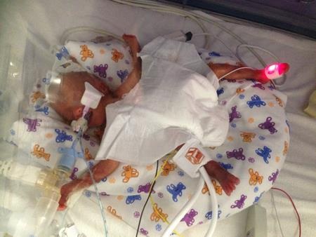 Phép màu đến với em bé được người anh em song sinh nhường cho sự sống - 2 Tilly có thể sống sót nhờ sự “hy sinh” của người anh sinh đôi