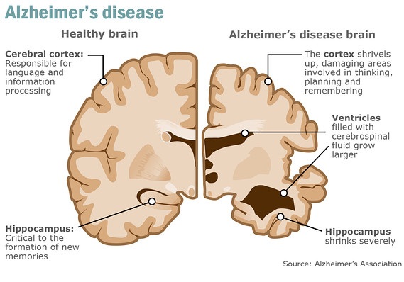 Sử dụng thuốc điều trị vi rút herpes để làm chậm bệnh Alzheimer - 1 Sử dụng thuốc điều trị vi rút herpes để làm chậm bệnh Alzheimer - 1