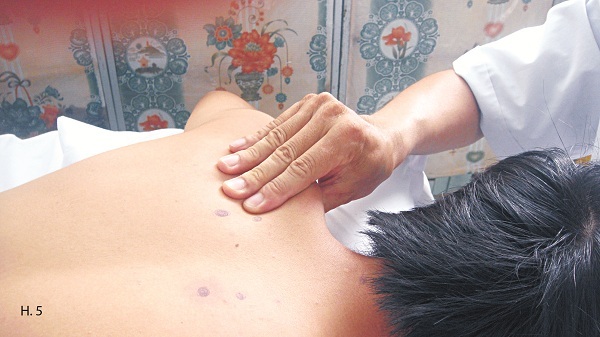 Xoa bóp chữa đau vai gáy do tư thế - 5 Hình 5