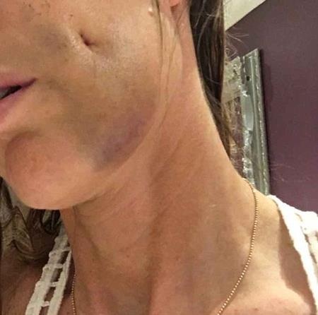 "Ghen tỵ" với con, mẹ chi 37 triệu để có má lúm đồng tiền - 4 Sau phẫu thuật má lúm đồng tiền, mặt AJ bị sưng và bầm tím