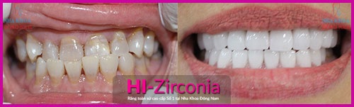 Cùng tìm hiểu về loại răng sứ mới nhất - 4
(Răng toàn sứ cao cấp Hi-Zirconia mang đến tính thẩm mỹ cao cho răng)