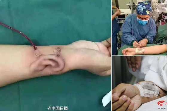 Tai nhân tạo “mọc” trên cánh tay củ bệnh nhân để thay thế tai bị mất trong tai nạn giao thông
