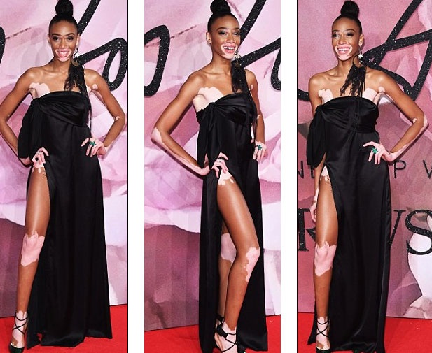 Váy xẻ táo bạo của người mẫu bạch tạng Winnie Harlow - 5 Váy xẻ táo bạo của người mẫu bạch tạng Winnie Harlow - 5