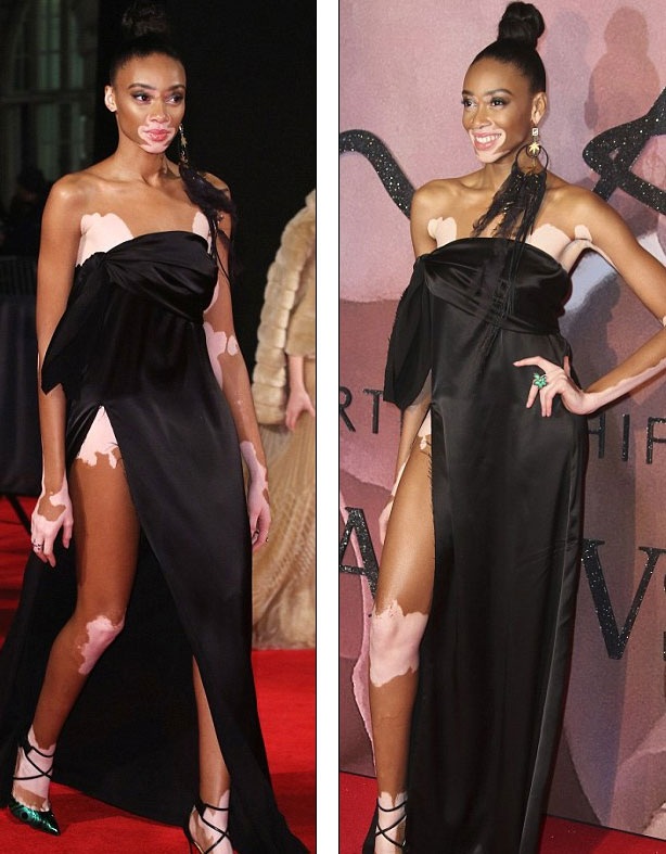 Váy xẻ táo bạo của người mẫu bạch tạng Winnie Harlow - 2
Cô diện váy quây cắt xẻ gợi cảm khoe đôi chân thon dài. Những vết bạch tạng trên cơ thể người đẹp giúp cô trở nên vô cùng đặc biệt. Nhưng chính sự tự tin giúp người đẹp 22 tỏa sáng trên thảm đỏ một sự kiện thời trang danh tiếng.