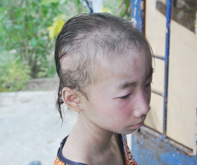 Thương bé gái bị lở loét khắp người phải nghỉ học vì không tiền chữa bệnh - 4 Tóc cháu Tiên cũng rụng dần với các căn bệnh vây lấy khiến cháu trở nên mặc cảm hơn.