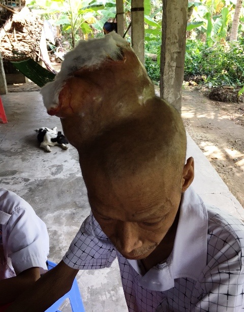 Thương bé lớp 7 chăm cả cha và mẹ đều mắc bệnh ung thư - 2 Vết thương đã lở loét trên đình đầu của ồng Tuyết
