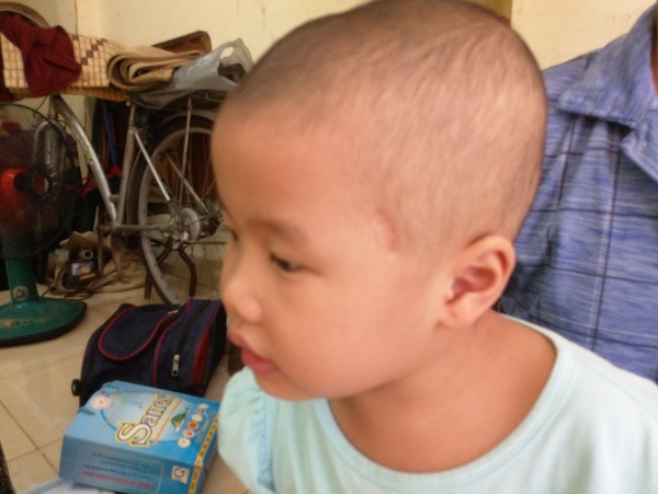 Cha bất lực nhìn con quằn quại trong cơn đau - 5 Vết mổ khối u vẫn còn để lại vết sẹo hằn sâu trên thái dương của bé Như Ngọc