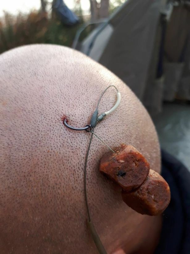 "Số nhọ" đi câu cá quăng móc câu trúng... đầu - 1
Hình ảnh móc câu găm trúng da đầu của Daan
