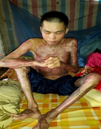 "Đổi đời" sau 7 lần phẫu thuật di chứng do bỏng lửa xăng - 1 Bệnh nhân Thanh Liêm ở thời điểm trước khi đến bệnh viện điều trị