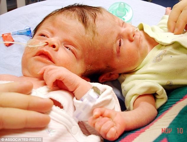 Tatiana và Krista trong những ngày tháng đầu đời.