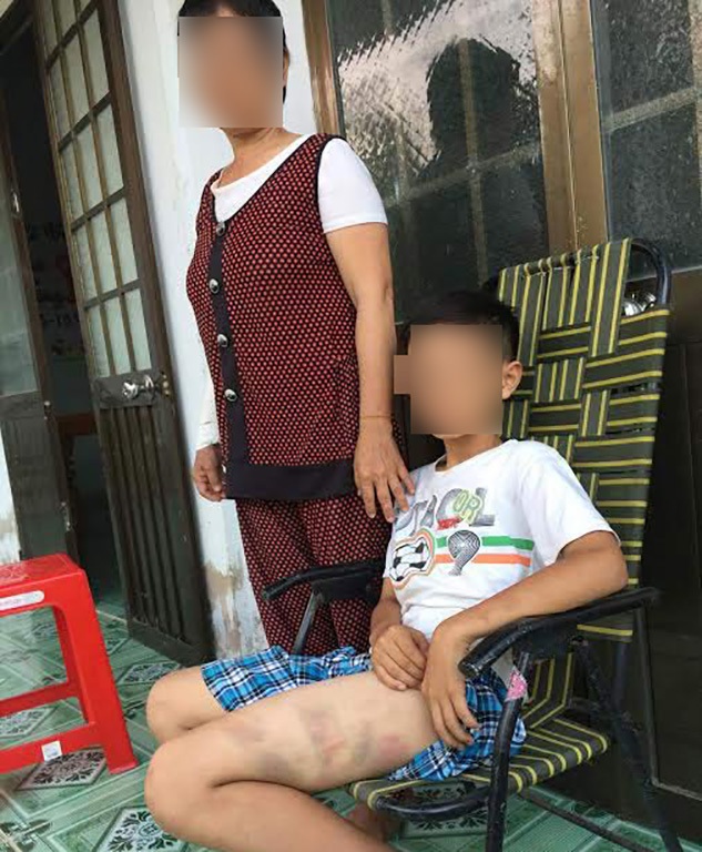 Cậu bé 13 tuổi bị bố đánh bầm dập vì mê chơi game - 1
Cháu H. bị bố đánh bị thương nên hai ngày qua không đi học được.