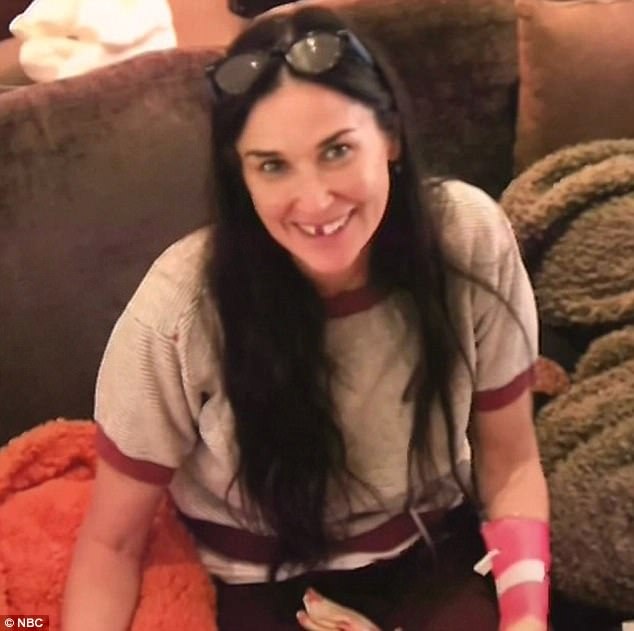 “Người đẹp không tuổi” tiết lộ bị… rụng răng vì căng thẳng - 2 Demi Moore cho biết hiện tại có hai chiếc răng cửa của cô là giả. Vốn được biết đến và ngưỡng mộ bởi vẻ đẹp bất chấp thời gian, nhưng Demi không ngần ngại cho thấy chân thực những tác động của tuổi tác, của áp lực cuộc sống đối với diện mạo của mình.