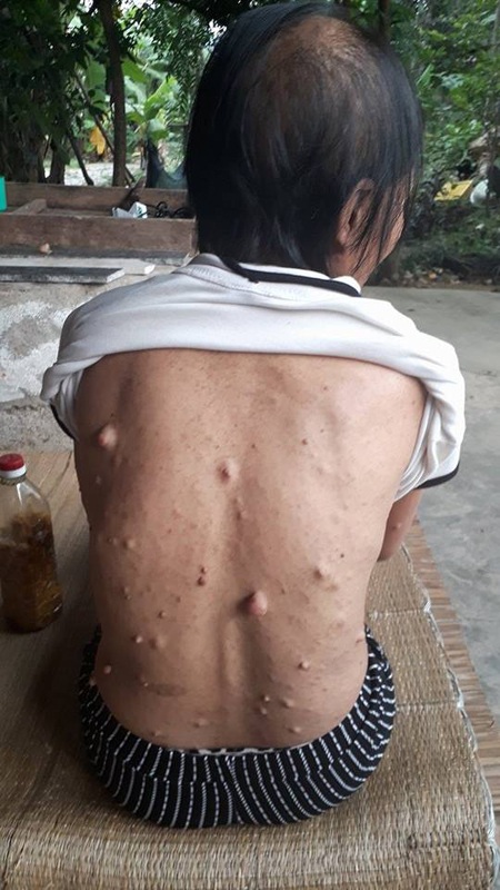 Khắp lưng bà Khuyên chi chít mụn nhọt. Nhiều chỗ mụt trồi to, căng đầy máu mủ, chỉ chực động vào là vỡ tung ra.