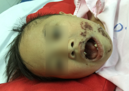 Xót xa những gương mặt con trẻ khôi ngô bỗng chốc "vỡ nát" vì tai nạn - 2 Hai hàm răng của bé Nhất H. chỉ còn sót lại vài chiếc, mặt của cháu bị biến dạng nghiêm trọng