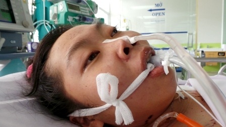Cô giáo trẻ nguy kịch vì một vết ong chích - 1
Tai họa từ vết ong chích bất ngờ giáng xuống, đe dọa cướp đi sinh mạng cô gái trẻ