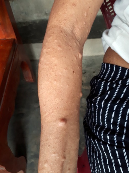 Cánh tay bà Khuyên nổi mụn và bắt đầu sưng lên.