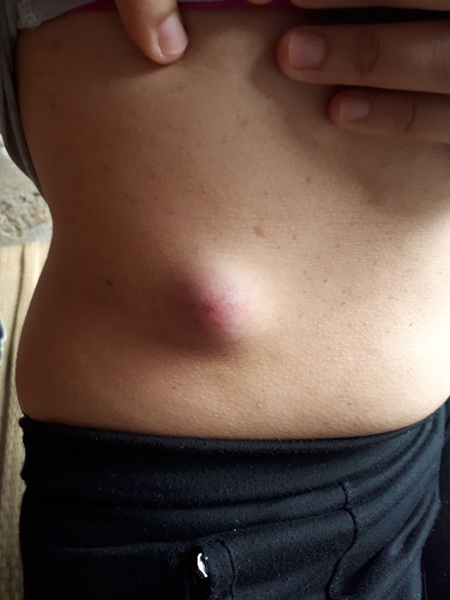 Cơ thể Lan Anh bắt đầu nổi mụn nhọt và đau