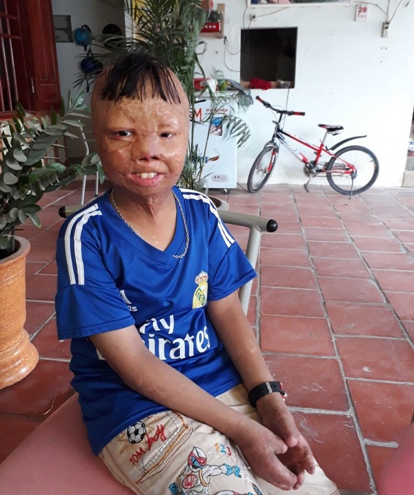 Ước mơ làm lính cứu hỏa của cậu bé bị cha tẩm xăng đốt - 4
Vì những ngón tay bị cụt ngủn nên việc viết chữ rất khó khăn đối với Linh. Cậu bé chịu nhiều thiệt thòi nhưng luôn vui vẻ, lạc quan.