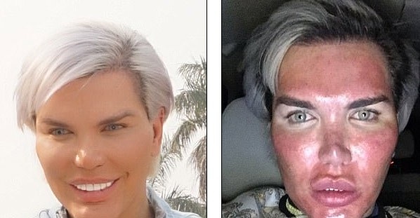 
Sao truyền hình thực tế 33 tuổi thừa nhận ca lột da bằng hóa chất này gây nhiều đau đớn nhưng anh vốn là người quan tâm tới nhan sắc nên hoàn toàn chấp nhận được
