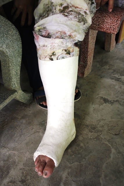 Thương bé lớp 7 chăm cả cha và mẹ đều mắc bệnh ung thư - 6 Bà Điệp vừa bị gãy chân phải băng bột