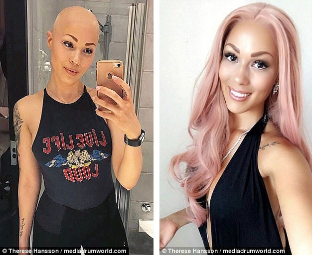 Cô gái trẻ có tên Therese Hansson, 26 tuổi, đến từ thành phố Malmö, Thụy Điển được chẩn đoán mắc chứng rụng tóc từ khi còn là một cô gái tuôi teen.
