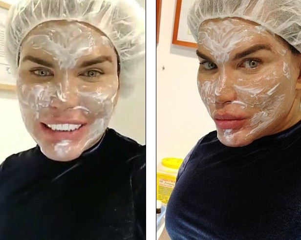 
Rodrigo Alves luôn hướng tới hình ảnh hoàn hảo của người mẫu và vì thế đã thực hiện gần 60 ca dao kéo làm đẹp trong vài năm qua với hi vọng có được nhan sắc như trong mơ
