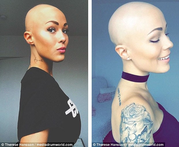 Therese muốn mình trở thành nguồn cảm hứng cho những người gặp chứng rụng tóc, để họ cảm thấy tự tin hơn trong cuộc sống.