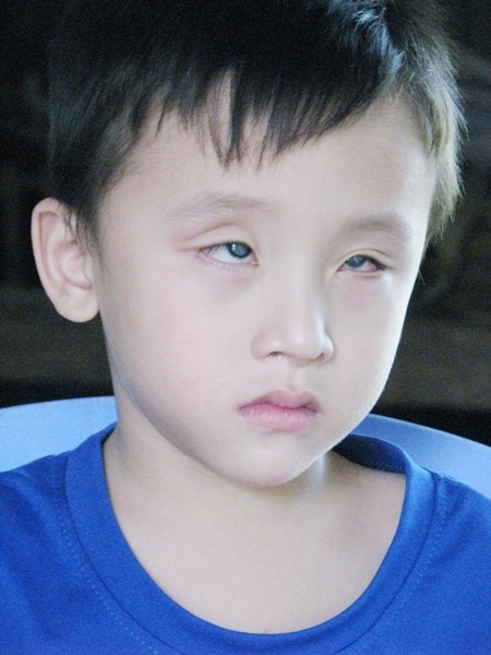“Mẹ ơi, con muốn sáng mắt !” - 1 Cháu Nguyễn Đức Trung bị đục thủy tinh thể làm mờ cả 2 mắt từ 4 năm qua.
