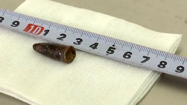 Tìm thấy nắp bút biến dạng kẹt trong phổi gần hai thập kỷ - 1 Tìm thấy nắp bút biến dạng kẹt trong phổi gần hai thập kỷ - 1