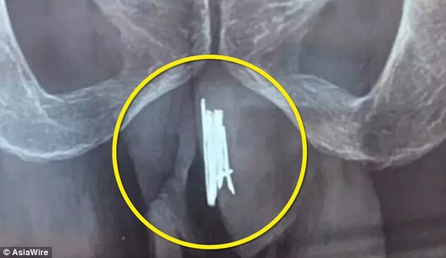 Kinh dị người đàn ông nhét 15 cây kim vào của quý - 1 
15 cây kim được tìm thấy trong của quý