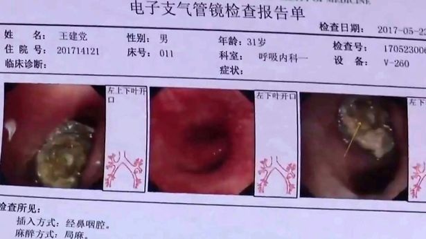 Tìm thấy nắp bút biến dạng kẹt trong phổi gần hai thập kỷ - 2 Tìm thấy nắp bút biến dạng kẹt trong phổi gần hai thập kỷ - 2