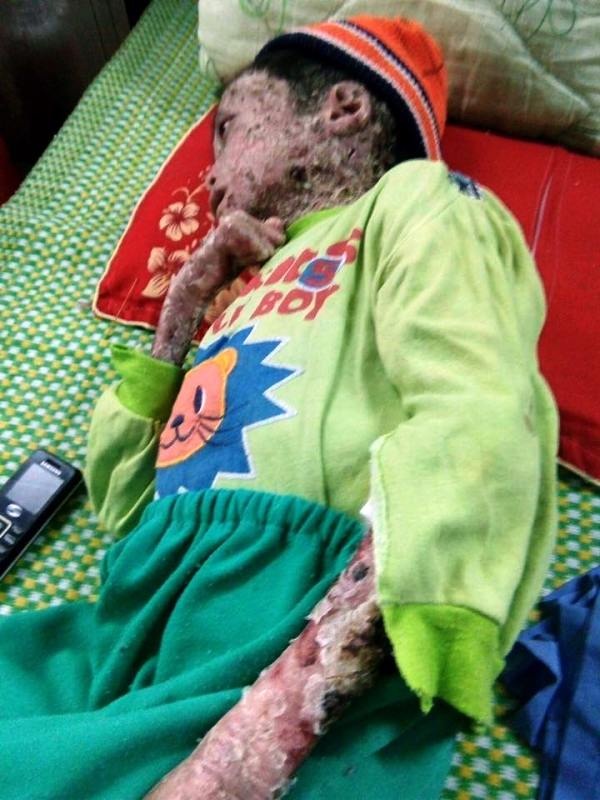 Toàn thân phủ "vỏ cây khô", chàng trai 17 tuổi chỉ nặng 9kg - 4 Toàn thân thể Tài phủ một lớn da nhăn nheo, khô như vỏ cây, lúc nào cũng rỉ máu.