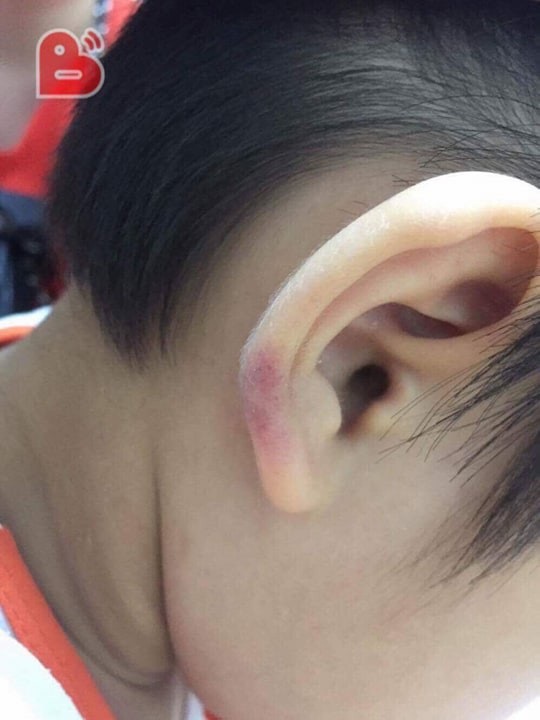 Hà Nội: Cô giáo mầm non đánh con riêng của chồng phải nhập viện - 1 Vết bầm tím trên người cháu bé (ảnh: Internet)