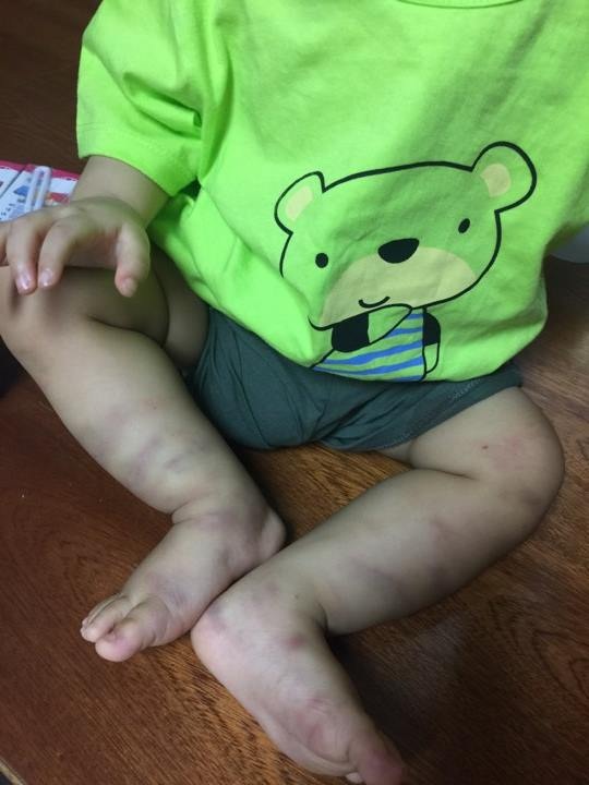 Hà Nội: Bé 1 tuổi bầm dập chân, đầu, vùng sinh dục nghi do bạo hành - 3
Bé vào viện trong tình trạng sợ hãi, đói nhưng rất ngoan, ai bế bé cũng theo