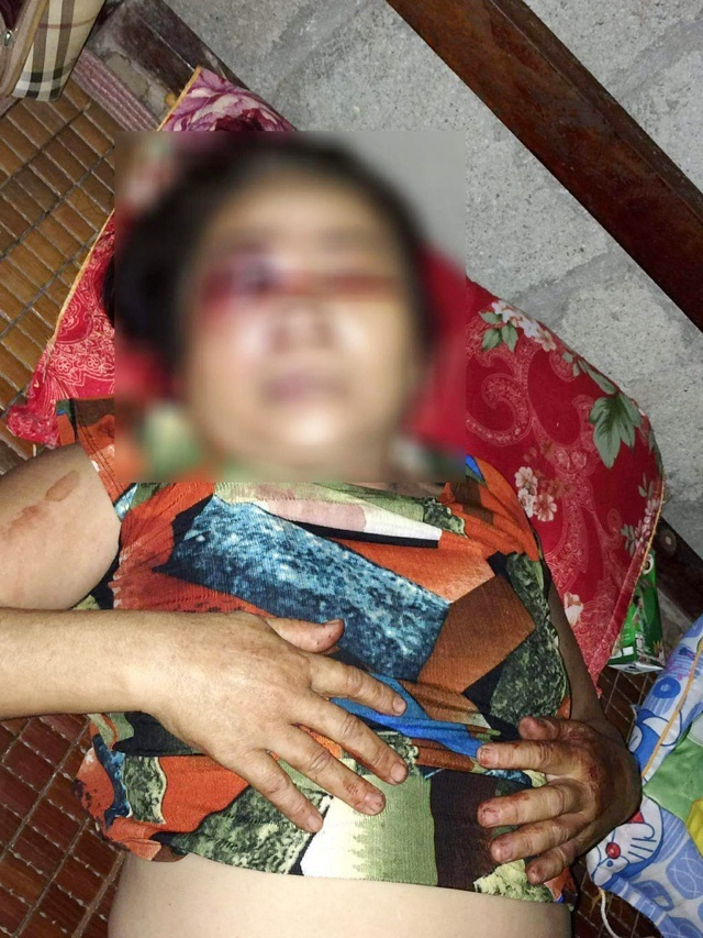 Bà Y. bị đánh hỏng mắt trên chiếu bài khi chơi xì lát với Hân