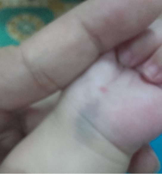 Cha ung thư, bé trai 2 tuổi bại não đếm sự sống từng ngày - 4 Bàn tay nhỏ bé luôn tím bầm vì những vết kim tiêm thuốc