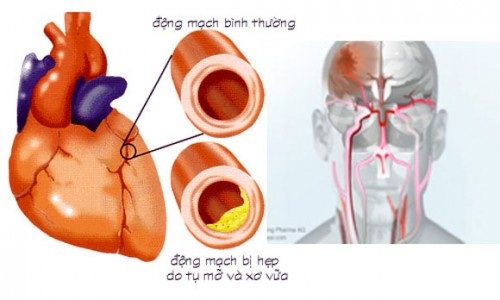 Ăn uống tốt, người khỏe mạnh… bỗng chốc “sống chung” với bệnh? - 1
Rối loạn mỡ máu làm tăng nguy cơ mắc các bệnh lý tim mạch.