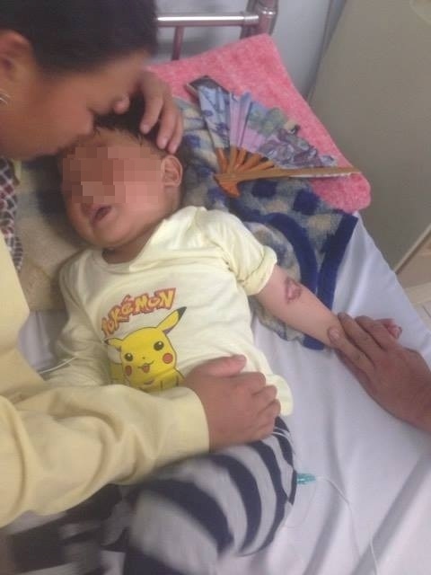 Nhầm gói hóa chất là đường, bé trai 3 tuổi bị bỏng thực quản - dạ dày - 1 Bệnh nhi đã dần ổn định sau hơn 10 ngày điều trị. Ảnh: BS cung cấp.