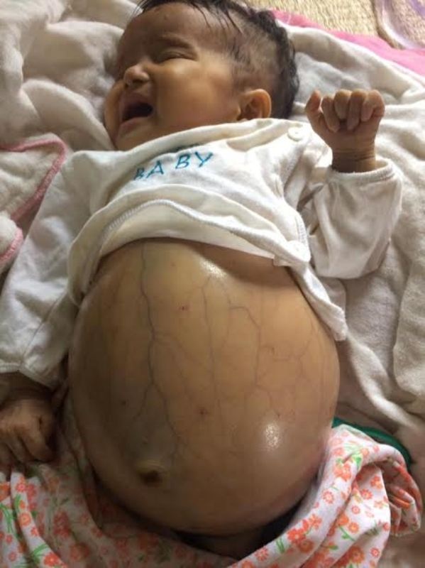 Mới được 3 tháng tuổi nhưng bé Hải Dương cùng lúc bé đã phải mang trong mình căn bệnh nhiễm trùng huyết, rối loạn đông máu và viêm phổi do vi khuẩn