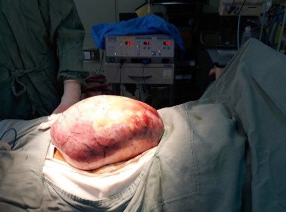 Thiếu nữ mang khối u buồng trứng “khổng lồ” nặng 5kg - 1
khối u buồng trứng “khổng lồ” nặng 5kg ở thiếu nữ đã được phẫu thuật thành công