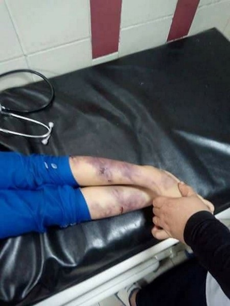 Bé gái 5 tuổi bị cha đánh chết vì không làm bài tập - 2 Đôi chân sưng phù và bầm tím của bé gái đáng thương