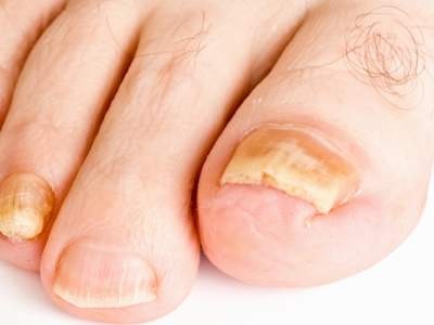 Bàn chân tiết lộ điều gì về sức khỏe? - 4 Bàn chân tiết lộ điều gì về sức khỏe? - 4