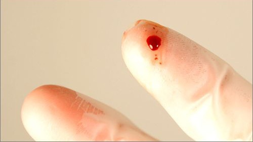 Làm gì khi có nguy cơ phơi nhiễm HIV? - 1 Làm gì khi có nguy cơ phơi nhiễm HIV? - 1