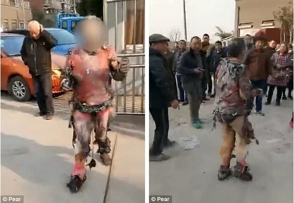 Suýt chết vì lao vào nhà cháy để cứu... điện thoại - 1 Người đàn ông bị bỏng và áo quần tan nát sau khi đi ra từ đám cháy