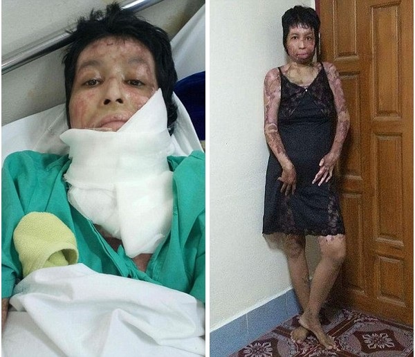 Vợ bị chồng thiêu sống vì đăng ảnh “tự sướng” lên Facebook - 2 Tarrin bị bỏng khắp cơ thể và cần phải tiếp tục phẫu thuật để ghép da