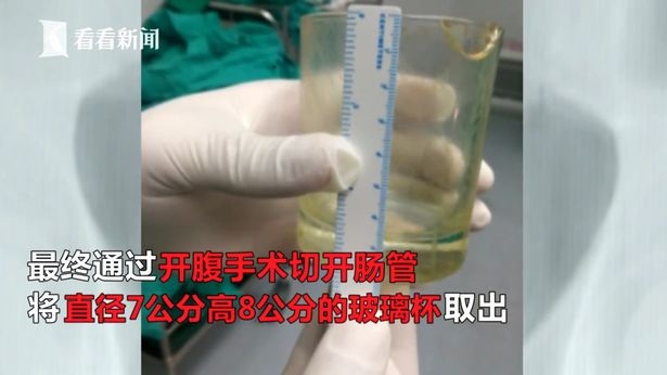 Giải cứu bệnh nhân bị kẹt chiếc cốc dài 8cm trong trực tràng - 3