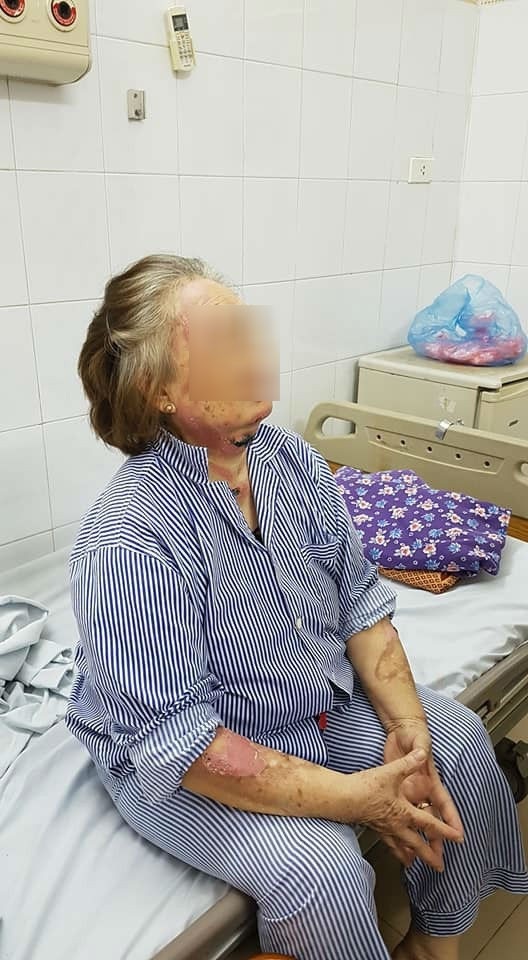 Gần 100% ca bỏng cồn do nướng mực, nướng cá - 1 
Bà T.B.Y vô tình bị bỏng cồn do người nhà không để ý khi nướng mực, cho rằng cồn đã cháy hết, đổ chai cồn vào và bị bén lửa. Ảnh: H.Hải.