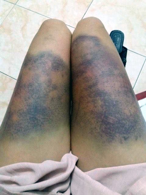 Hà Nội: Điều tra vụ thiếu phụ nghi bị người tình đánh bầm tím người - 1 Hà Nội: Điều tra vụ thiếu phụ nghi bị người tình đánh bầm tím người - 1